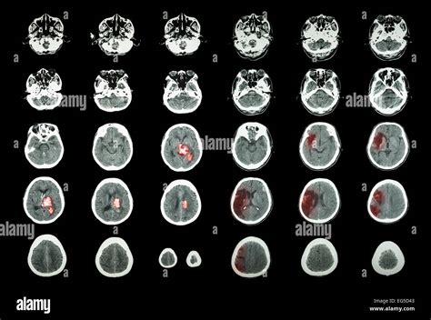 Hemorrhagic Stroke and Ischemic Stroke . CT scan of brain : intracerebral hemorrhage ( 3 left ...