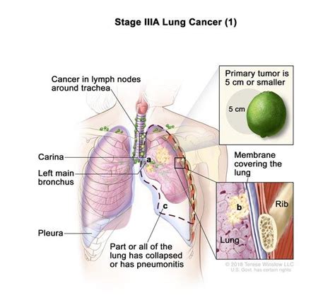 Adjuvant Immunotherapy Approved for Lung Cancer - NCI