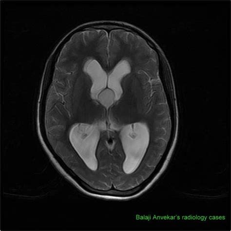 Dr Balaji Anvekar FRCR: Colloid cyst MRI