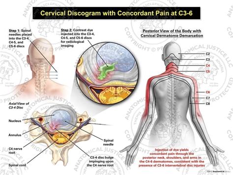 Female Right Cervical Discogram with Concordant Pain at C3-6