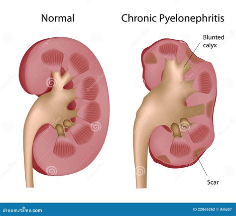 Pielonefritis Crónica Del Riñón Ilustración del Vector - Ilustración de cruz, icono: 22866262