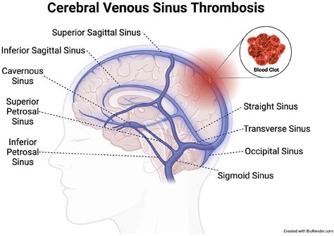 Vascular Disease Patient Information Page: Venous thrombosis at unusual sites - Marcelo PV Gomes ...