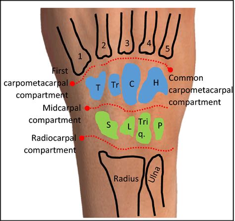 Anatomical compartments of the wrist (schematic representation). Early ...