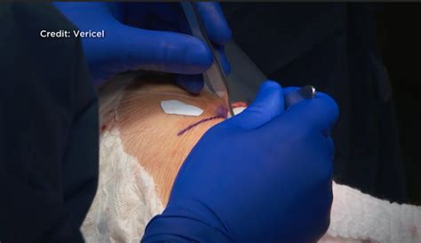 MACI procedure offering a different approach to knee surgery | KX NEWS