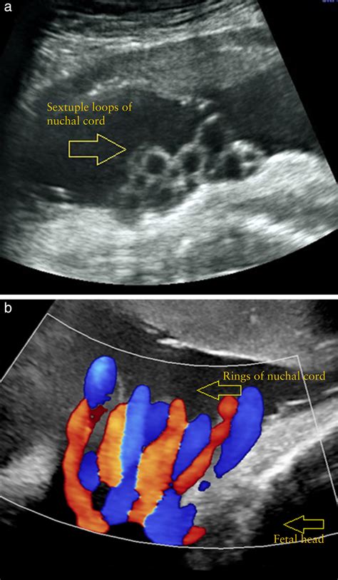 Nuchal Cord Ultrasound