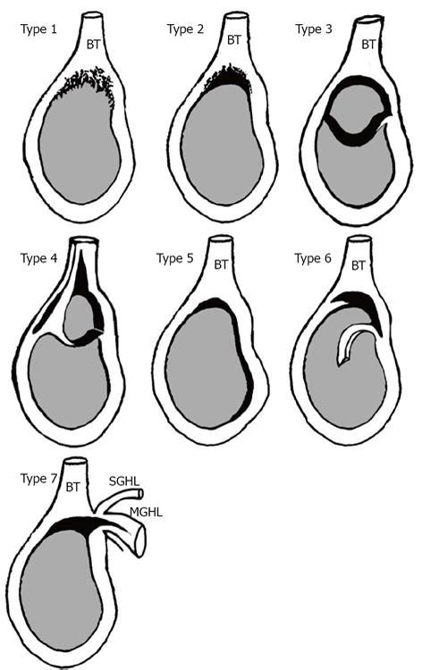 Superior labrum anterior to posterior lesions of the shoulder: Diagnosis and arthroscopic management