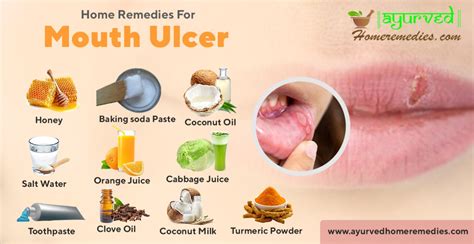 Home Remedies To Cure Mouth Ulcers | How To Get Rid Of Canker Sores | Ayurvedic Remedies For ...