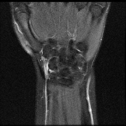 Ulnar Collateral Ligament Wrist Mri