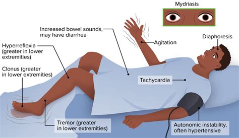 Neuroleptic Malignant Syndrome | Concise Medical Knowledge