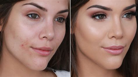 How To Cover Your Acne Without Makeup | Makeupview.co