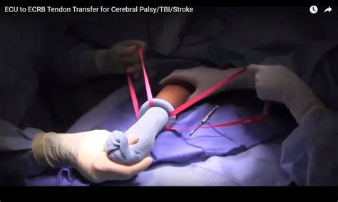 ECU to ECRB Tendon Transfer for Cerebral Palsy/Stroke — OrthopaedicPrinciples.com