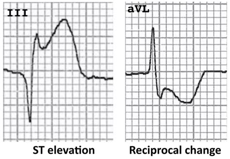 The ST Segment • LITFL • ECG Library Basics