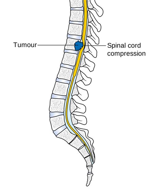 How to Treat Spinal Cord Tumors | Top Natural Remedies