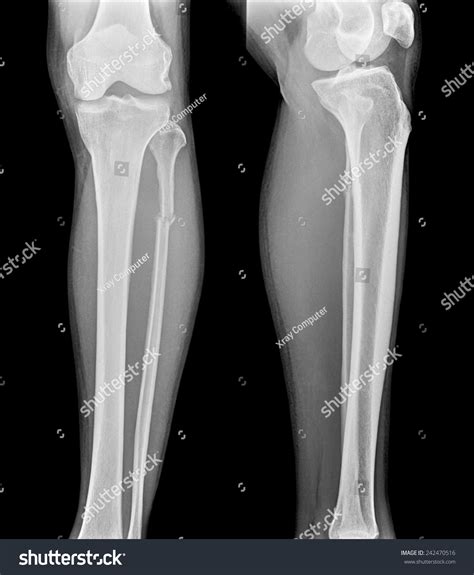 Xray Film Proximal Tibia Intra Articular Stock Photo 242470516 - Shutterstock