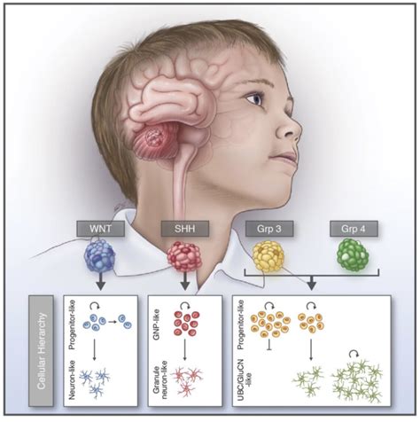 Resolving medulloblastoma cellular architecture by single-cell genomics. | Suva Laboratory ...