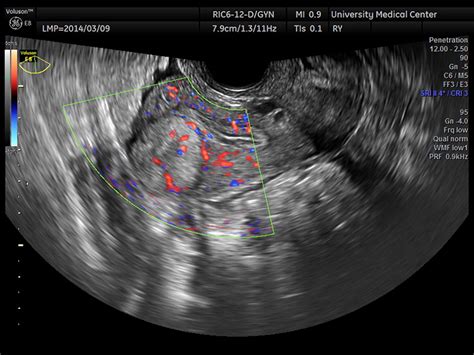 Vaginal Ultrasound Showing Atrophy Of The Uterus And Ovaries | Hot Sex Picture