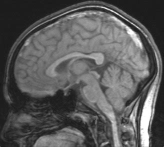 MRI brain showing superior sagittal sinus thrombosis (sagittal view). | Download Scientific Diagram