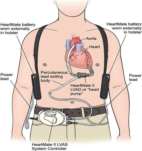 The heart mate II [4]. | Download Scientific Diagram