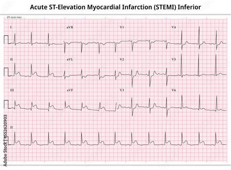 Acute ST-Elevation Myocardial Infarction (STEMI) Inferior - ECG Paper ...