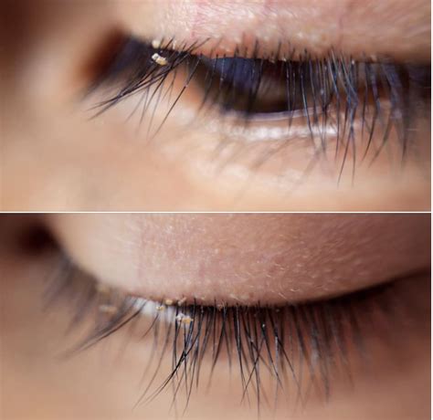 Love your lashes? Beware of lash lice!