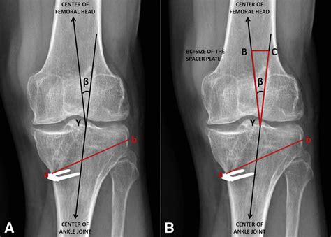 Opening Wedge High Tibial Osteotomy And Anterior Cruciate Ligament | My ...