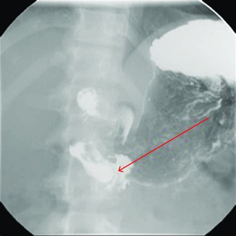 False lumen, indicated by the arrow, as seen on upper endoscopy. The... | Download Scientific ...