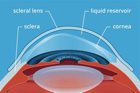 Fully Customized Mini-Scleral Lenses (For Adults) | Aerov Pte. Ltd. | SG