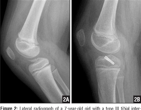 Figure 2 from Physeal-sparing tibial eminence fracture fixation with a headless compression ...