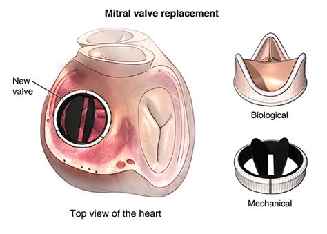 Rheumatic Heart Disease | Johns Hopkins Medicine