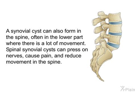 PatEdu.com : Spinal Synovial Cysts