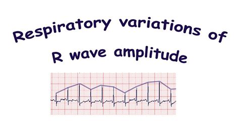 How To Measure Qrs Amplitude