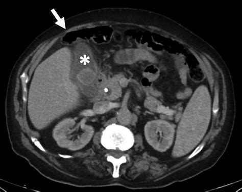 Transhepatic cholecystostomy for percutaneous biliary drainage.... | Download Scientific Diagram