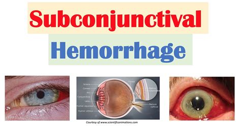 Subconjunctival Hemorrhage (Blood in Eye) | Causes, Signs & Symptoms ...