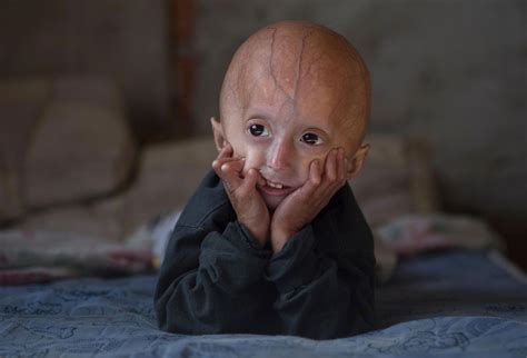 Progeria | Definition, Types, Symptoms, Syndrome, & Facts | Britannica