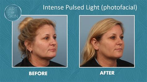 IPL Photofacial face for rosacea and sun spots - YouTube