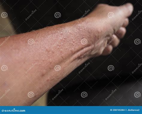 Symptoms of Contact Allergy on Hand Skin Stock Photo - Image of human, body: 208745384