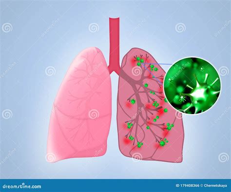 Illustration of Human Lungs Affected with Disease on Blue Background ...