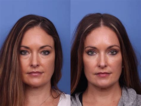 Blepharoplasty Before and After Photo Gallery | Scottsdale & Phoenix, AZ | Hobgood Facial ...