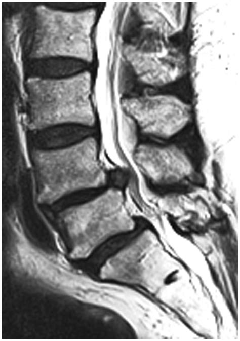 Herniated Disc Thoracic Mri