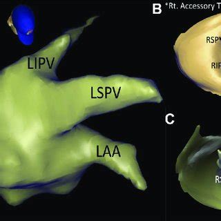 Left atrium in a patient with a right accessory top pulmonary vein: (A)... | Download Scientific ...