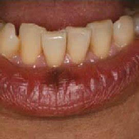 A brown macule on the vermilion border of the lower lip. | Download Scientific Diagram