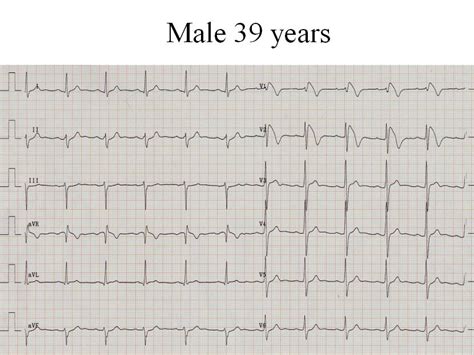 Brugada Syndrome - Symptoms, Causes, Treatment, Prevention and Prognosis