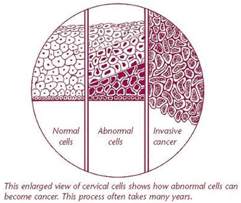 Pap Smear Abnormal Result – Telegraph