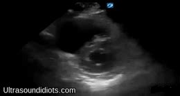Ultrasound Idiots — Pulmonary Embolism Image Archive