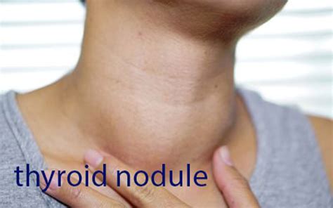 What Is A Thyroid Nodule? - Are All Them Serious And Must Be Treated?