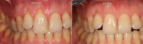 Receding Gums Pin Hole Surgery & Soft Tissue Grafting In London