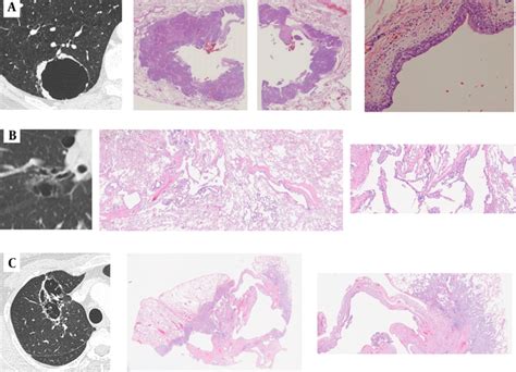 Cystic and Cavitary Lung Cancer: Its Characteristic Features on CT and FDG-PET Scans | Iranian ...