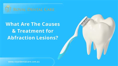 PPT – What Are The Causes & Treatment for Abfraction Lesions ...