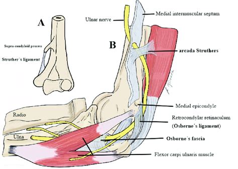 In "A" the location of the supracondylar ligament and the supracondylar ...