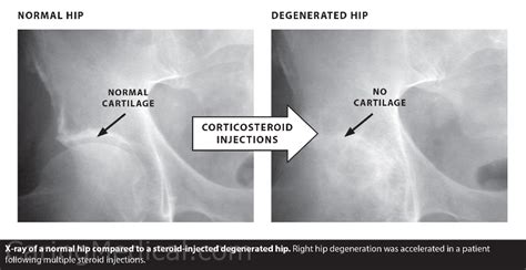 The different kinds of injections for bone on bone hip – Caring Medical Florida